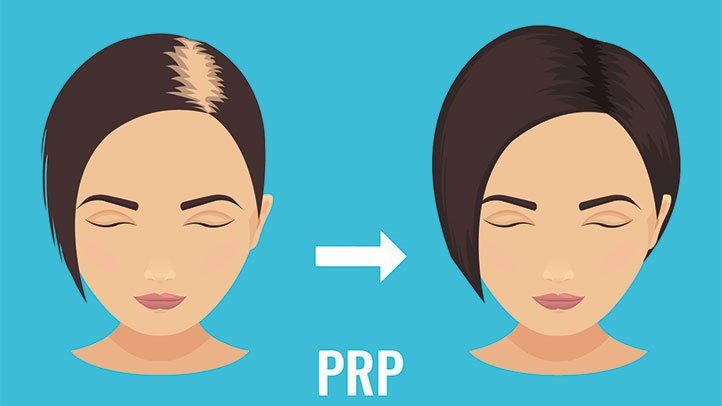 PRP Hair regrowth